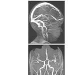 Cranial Imaging (MRV and MRA)