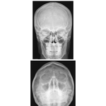 Skull: Radiographs