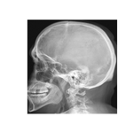 Skull: Lateral Radiograph