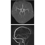 Cranial Imaging (MRA and MRV)