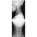 Cervical Spine: Radiographs