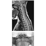 Cervical Spine: MRI and Radiograph