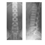 Lumbar Vertebrae: Radiographs