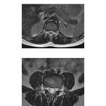 Lumbar Spine: MRIs