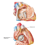 Right Atrium and Ventricle