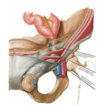 Indirect Inguinal Hernia