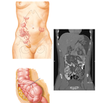 (Vermiform) Appendix