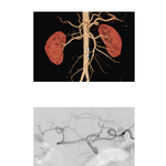 Celiac Arteriogram and CT Angiogram