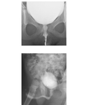 Male and Female Cystourethrograms