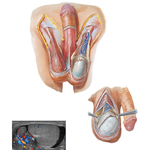 Scrotum and Contents