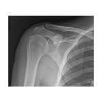 Shoulder: Anteroposterior Radiograph
