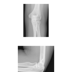 Elbow: Radiographs