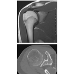 Shoulder MRI and CT Scan