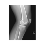 Knee Radiograph: Lateral View