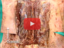 Vertebral Column and Its Contents: Step 2. Epidural space and dura mater  