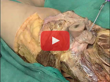 Female Pelvic Viscera: Step 5. Pelvic ligaments and uterine tube  