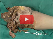 Somatic Nerves of the Greater and Lesser Pelvis; Pelvic Diaphragm: Step 7. Obturator internus fascia