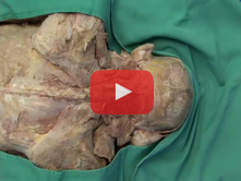 Posterior Neck and Suboccipital Region: Step 5. Suboccipital triangle