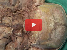 Posterior Neck and Suboccipital Region: Step 6. Exposure of the posterior arch of C1 and related str