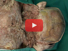 Posterior Neck and Suboccipital Region: Step 7. Vertebral artery and suboccipital nerve