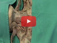 Anterior Neck: Step 6. Infrahyoid and digastric muscles; submandibular gland  