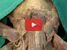 Anterior Neck: Step 7. Subdivisions of the anterior triangle  