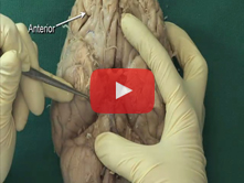 Brain: Step 2. Diencephalon: mammillary bodies, pituitary gland, tuber cinereum, optic nerves, and p
