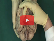 Brain: Step 5. Medulla oblongata: olive, pyraminds, apertures, and choroid plexus of the fourth vent