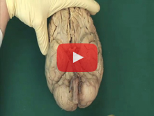 Brain: Step 6. Cerebral arterial circle (of Willis)