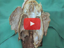 Brain: Step 9. CN III, V, and VI in the floor of the cranial cavity; trigeminal cave and ganglion; m
