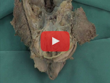 Eye and Orbit I: Step 2. Frontal nerve  