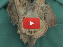 Eye and Orbit I: Step 3. Superior oblique muscle; trochlear and lacrimal nerves  